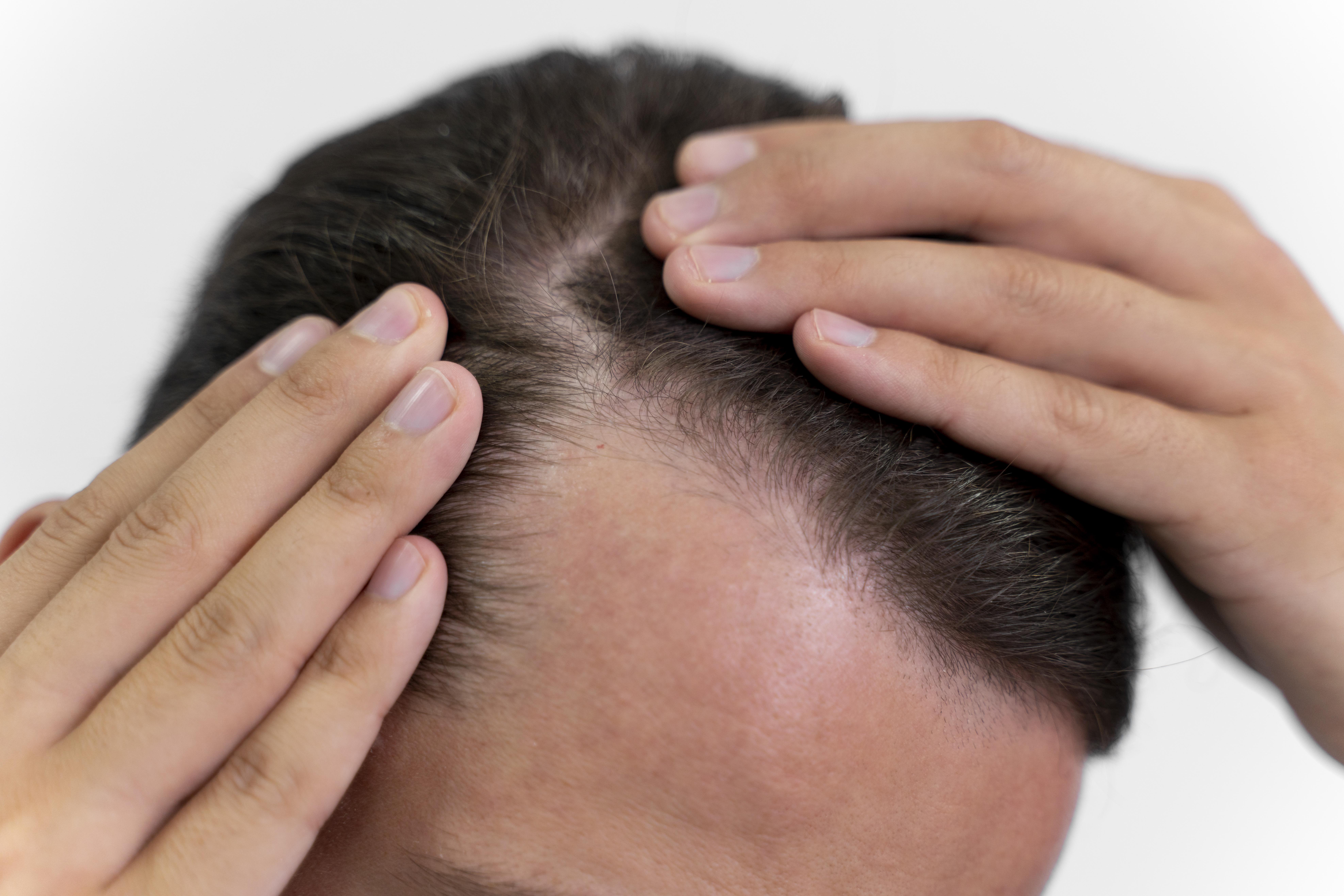 5 erros que podem acelerar a queda de cabelo e fazer a calvície avançar mais rápido
